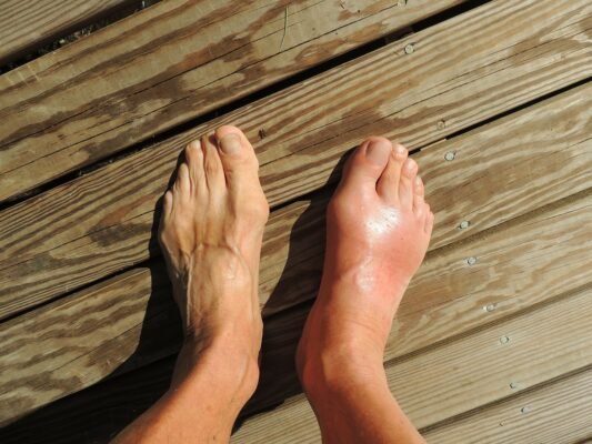 gout in patients on lipid lowering treatment bempedoic acid