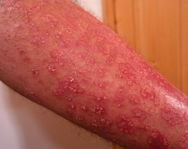 Biologics for Psoriasis (TNF, IL-23, IL-39, IL-17, and CD-6 Inhibitors)